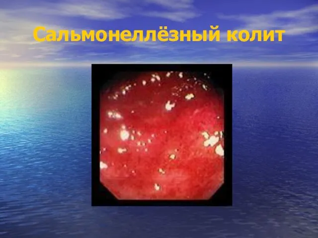 Сальмонеллёзный колит