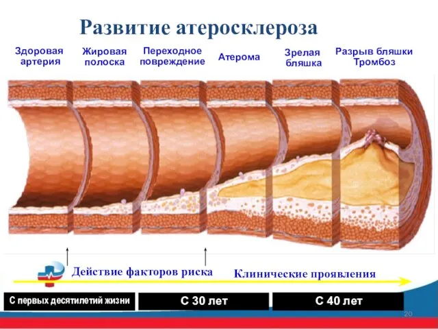 Развитие атеросклероза Здоровая артерия Жировая полоска Переходное повреждение Атерома Зрелая бляшка