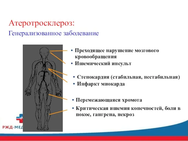 Атеротросклероз: Генерализованное заболевание Преходящее нарушение мозгового кровообращения Ишемический инсульт Стенокардия (стабильная,