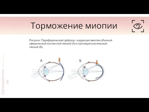 Торможение миопии Ортокератология Рисунок. Периферический дефокус: коррекция миопии обычной сферической контактной