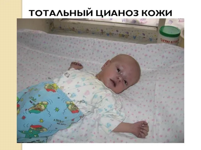 ТОТАЛЬНЫЙ ЦИАНОЗ КОЖИ