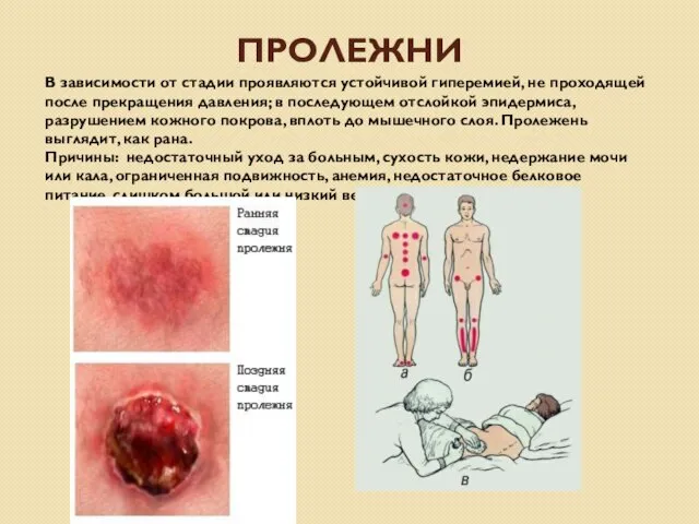 ПРОЛЕЖНИ В зависимости от стадии проявляются устойчивой гиперемией, не проходящей после