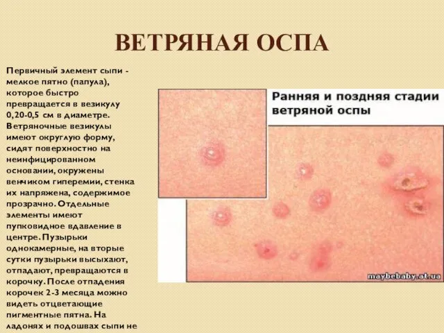 ВЕТРЯНАЯ ОСПА Первичный элемент сыпи - мелкое пятно (папула), которое быстро