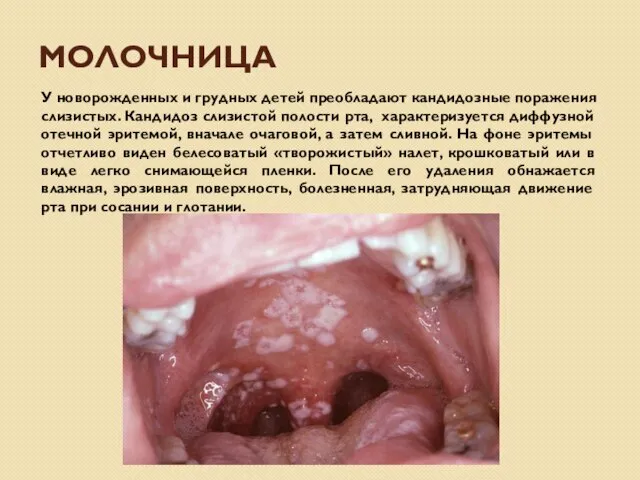 МОЛОЧНИЦА У новорожденных и грудных детей преобладают кандидозные поражения слизистых. Кандидоз