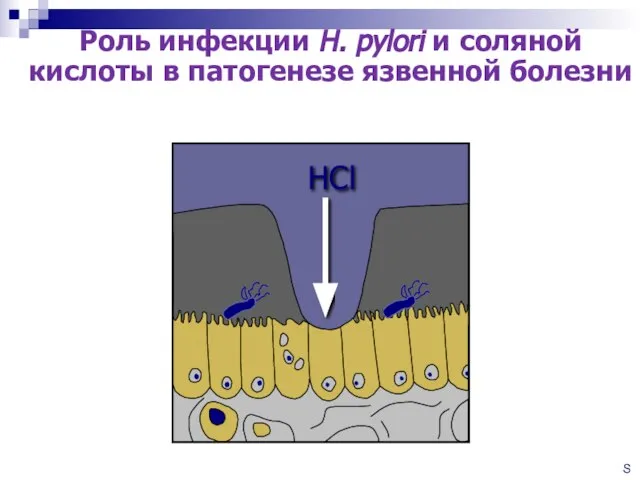 Роль инфекции H. pylori и соляной кислоты в патогенезе язвенной болезни