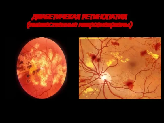 ДИАБЕТИЧЕКАЯ РЕТИНОПАТИЯ (множественные микроаневризмы)