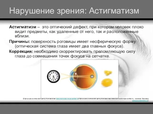 Нарушение зрения: Астигматизм Астигматизм – это оптический дефект, при котором человек