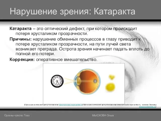 Нарушение зрения: Катаракта Катаракта – это оптический дефект, при котором происходит