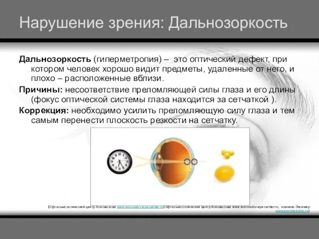 Нарушение зрения: Дальнозоркость Дальнозоркость (гиперметропия) – это оптический дефект, при котором