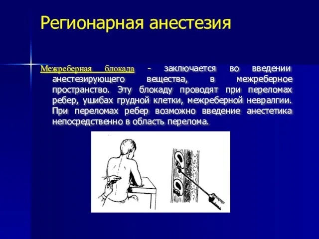 Регионарная анестезия Межреберная блокада - заключается во введении анестезирующего вещества, в