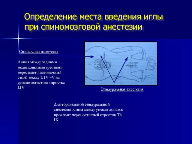 Определение места введения иглы при спиномозговой анестезии Эпидуральная анестезия Спинальная анестезия