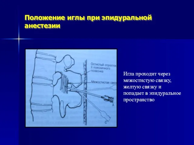 Положение иглы при эпидуральной анестезии Игла проходит через межостистую связку, желтую