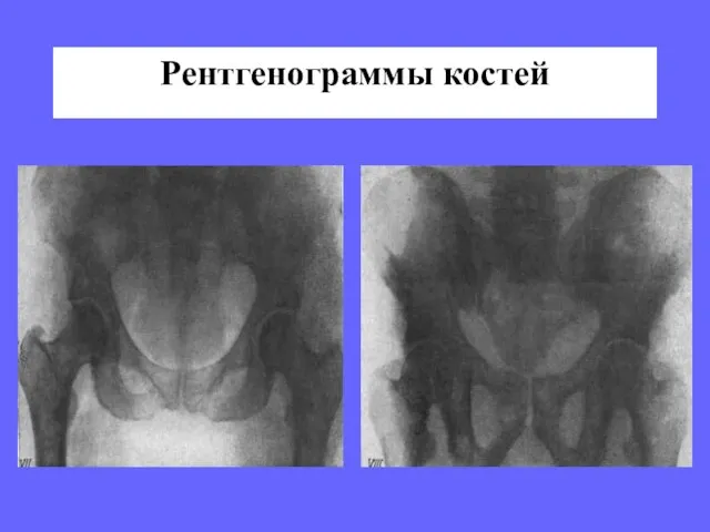Рентгенограммы костей
