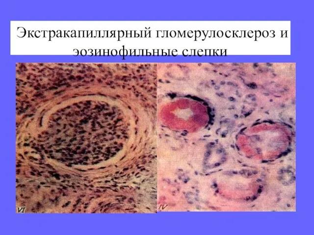 Экстракапиллярный гломерулосклероз и эозинофильные слепки