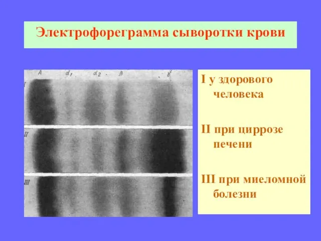 Электрофореграмма сыворотки крови I у здорового человека II при циррозе печени III при миеломной болезни