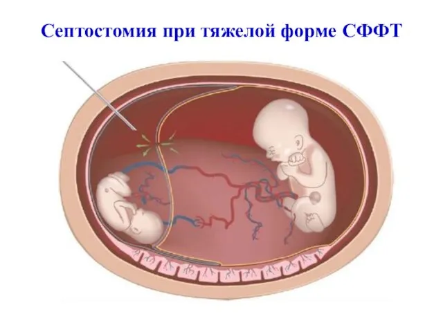 Септостомия при тяжелой форме СФФТ