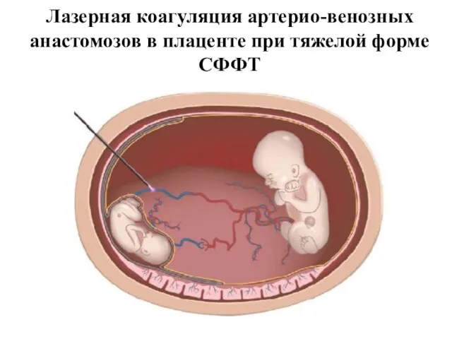 Лазерная коагуляция артерио-венозных анастомозов в плаценте при тяжелой форме СФФТ