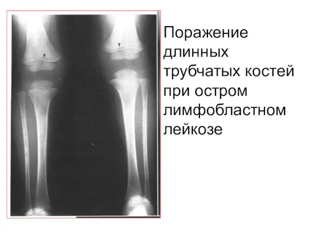 Поражение длинных трубчатых костей при остром лимфобластном лейкозе