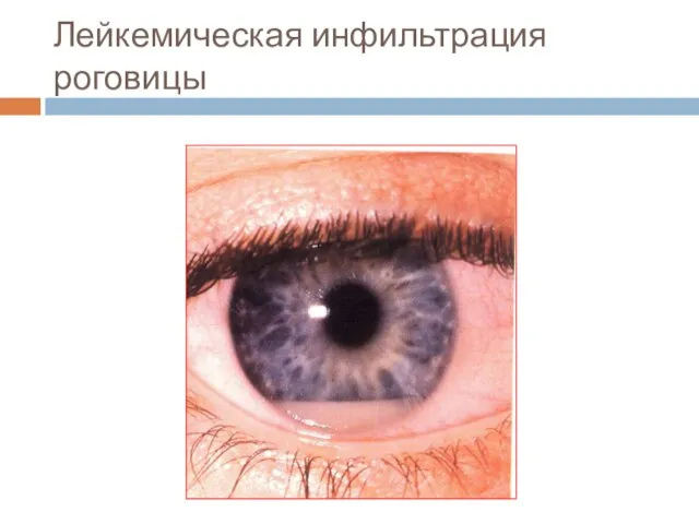 Лейкемическая инфильтрация роговицы