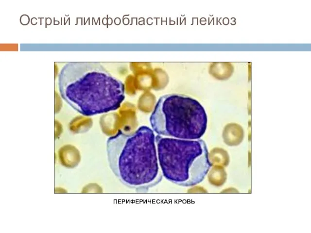 Острый лимфобластный лейкоз ПЕРИФЕРИЧЕСКАЯ КРОВЬ