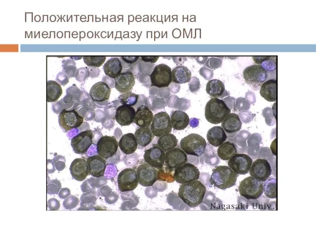 Положительная реакция на миелопероксидазу при ОМЛ