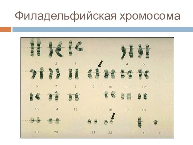 Филадельфийская хромосома