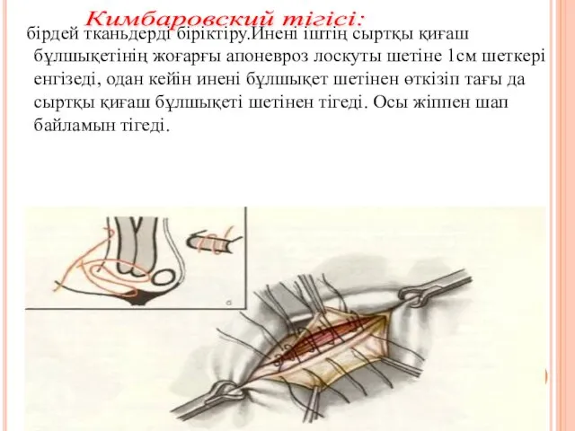 бірдей тканьдерді біріктіру.Инені іштің сыртқы қиғаш бұлшықетінің жоғарғы апоневроз лоскуты шетіне