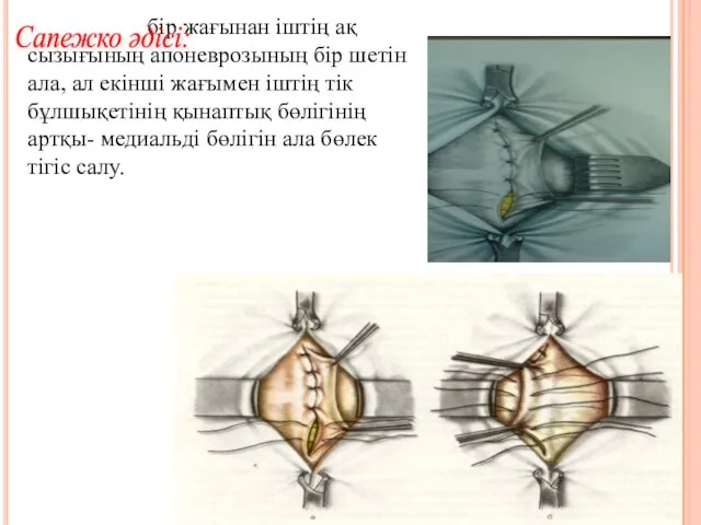 бір жағынан іштің ақ сызығының апоневрозының бір шетін ала, ал екінші