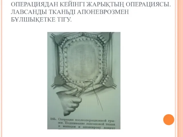 ОПЕРАЦИЯДАН КЕЙІНГІ ЖАРЫҚТЫҢ ОПЕРАЦИЯСЫ. ЛАВСАНДЫ ТКАНЬДІ АПОНЕВРОЗМЕН БҰЛШЫҚЕТКЕ ТІГУ.