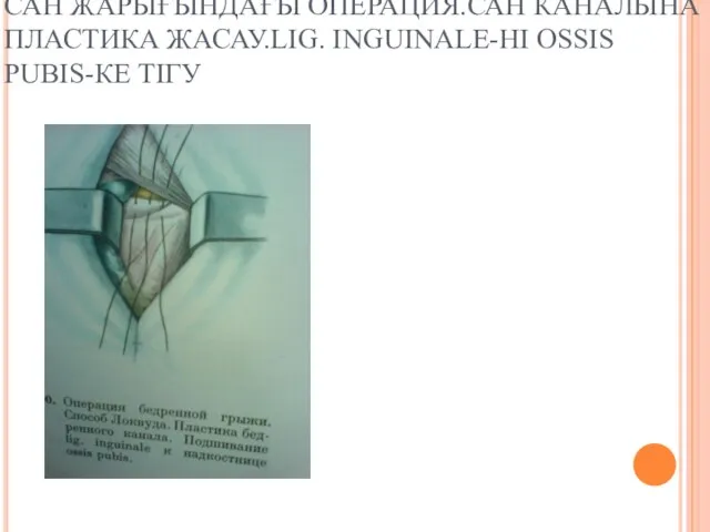 САН ЖАРЫҒЫНДАҒЫ ОПЕРАЦИЯ.САН КАНАЛЫНА ПЛАСТИКА ЖАСАУ.LIG. INGUINALE-НІ OSSIS PUBIS-КЕ ТІГУ