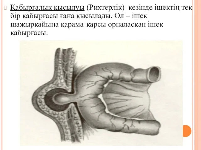 Қабырғалық қысылуы (Рихтерлiк) кезiнде iшектiң тек бiр қабырғасы ғана қысылады. Ол