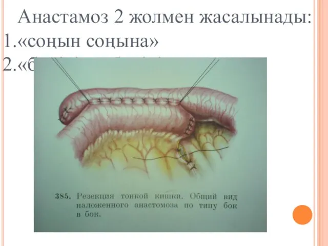 Анастамоз 2 жолмен жасалынады: «соңын соңына» «бүйiрiн – бүйiрiне»