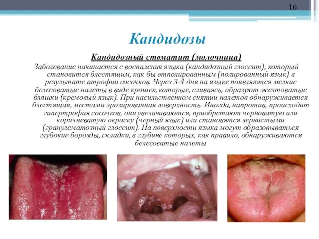 Кандидозы Кандидозный стоматит (молочница) Заболевание начинается с воспаления языка (кандидозный глоссит),