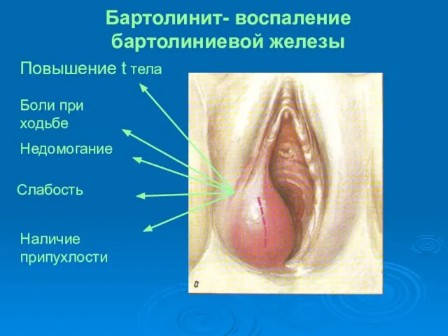 Бартолинит- воспаление бартолиниевой железы Повышение t тела Боли при ходьбе Недомогание Слабость Наличие припухлости