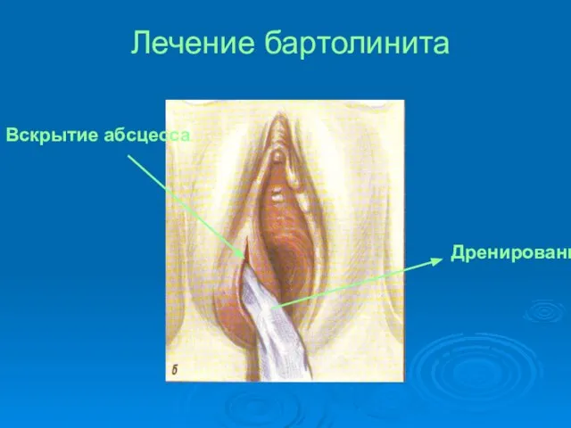 Лечение бартолинита Вскрытие абсцесса Дренирование