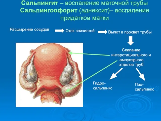 Сальпингит – воспаление маточной трубы Сальпингоофорит (аднексит)– воспаление придатков матки Расширение