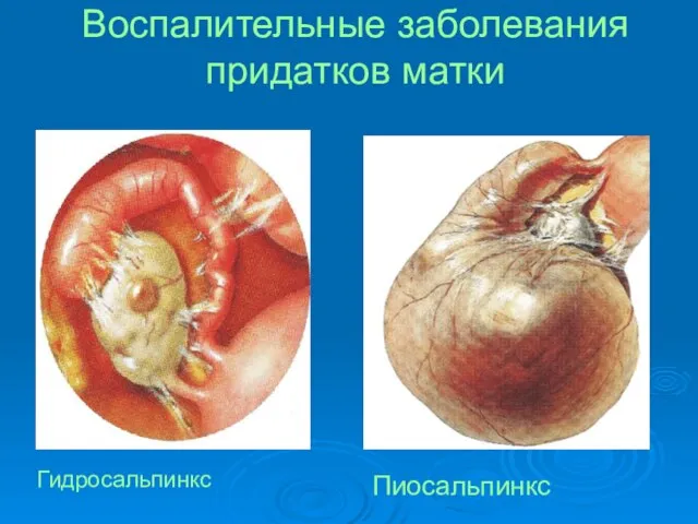 Воспалительные заболевания придатков матки Гидросальпинкс Пиосальпинкс