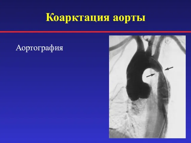 Коарктация аорты Аортография