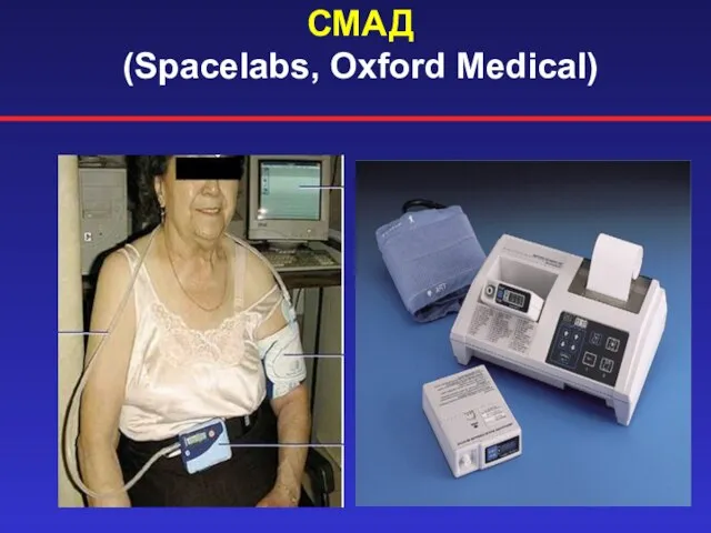 СМАД (Spacelabs, Oxford Medical)