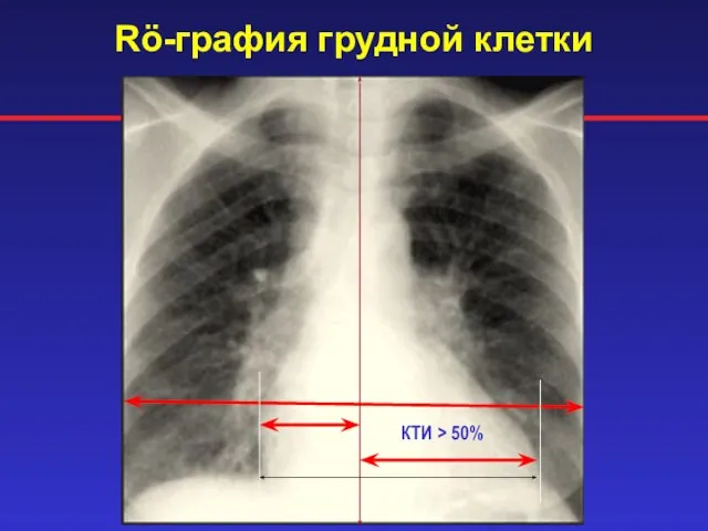 Rö-графия грудной клетки КТИ > 50%