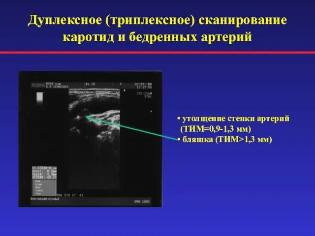 Дуплексное (триплексное) сканирование каротид и бедренных артерий утолщение стенки артерий (ТИМ=0,9-1,3 мм) бляшка (ТИМ>1,3 мм)