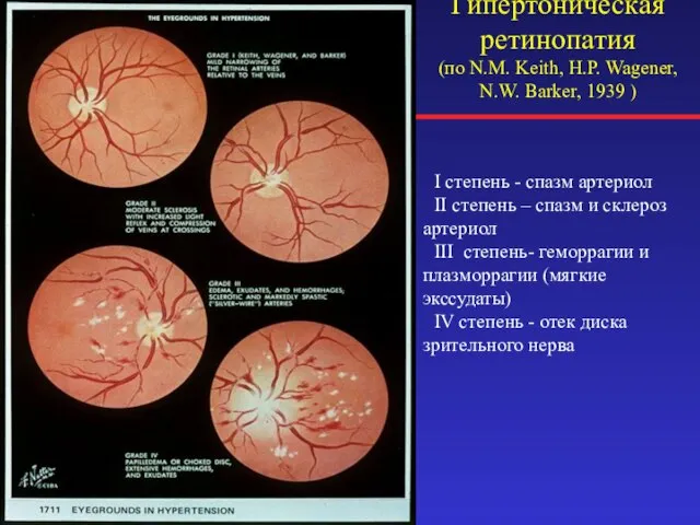 Гипертоническая ретинопатия (по N.M. Keith, H.P. Wagener, N.W. Barker, 1939 )