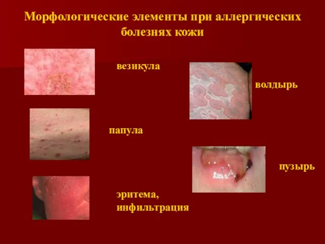 везикула папула эритема, инфильтрация волдырь пузырь Морфологические элементы при аллергических болезнях кожи