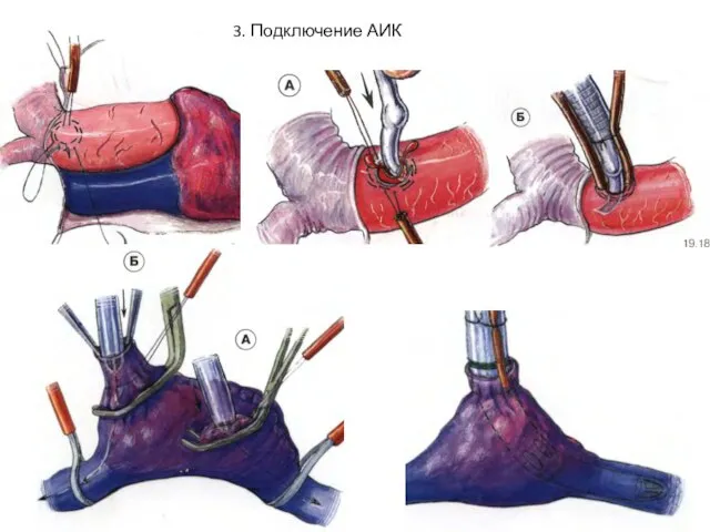 3. Подключение АИК