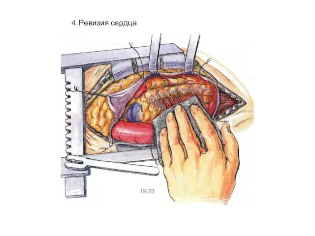 4. Ревизия сердца