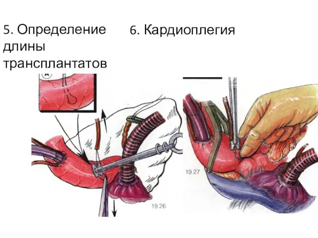 5. Определение длины трансплантатов 6. Кардиоплегия