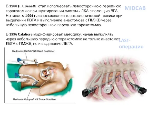 MIDCAB В 1988 F. J. Benetti стал использовать левостороннюю переднюю торакотомию