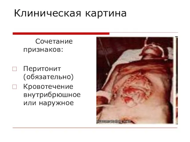 Клиническая картина Сочетание признаков: Перитонит (обязательно) Кровотечение внутрибрюшное или наружное