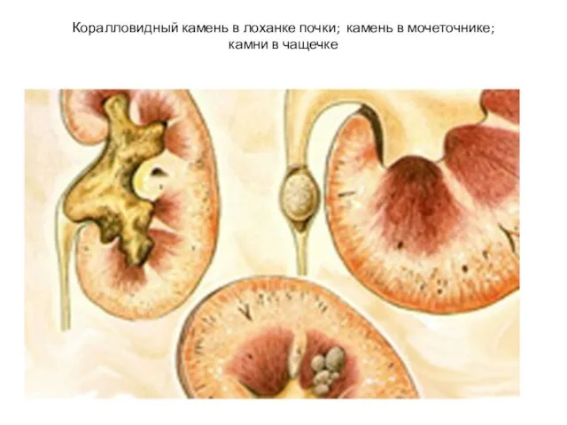 Коралловидный камень в лоханке почки; камень в мочеточнике; камни в чащечке