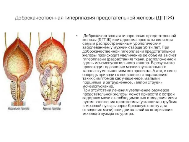 Доброкачественная гиперплазия предстательной железы (ДГПЖ) Доброкачественная гиперплазия предстательной железы (ДГПЖ) или